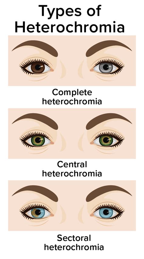 causes of heterochromia.